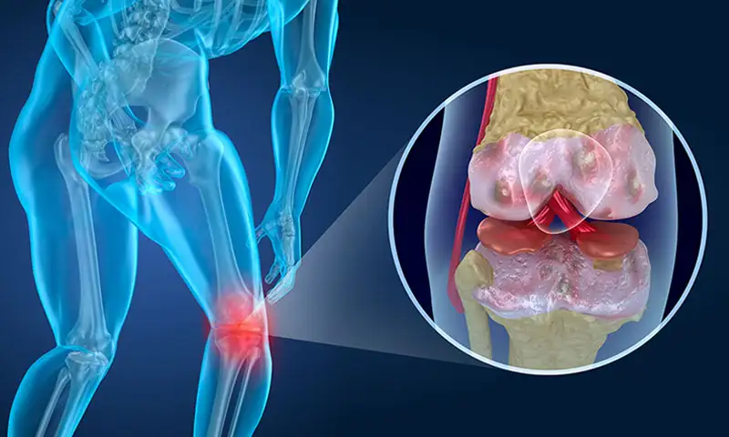 Arthritis - Biomagnetism therapy